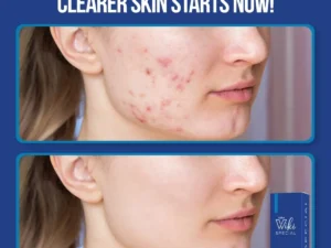 Wiki Special Anti Acne Serum 30ml | Clears Acne & Soothes Skin