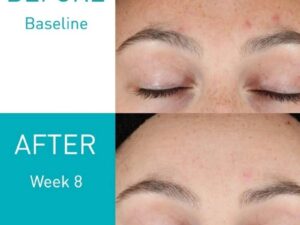 CeraVe Resurfacing Retinol Serum 30ml | Post-Acne Marks, Brightening & Pore Minimizer